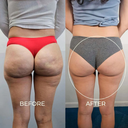 cellulite device UAE home use